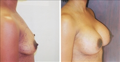 African American Breast Implants Patient Before & After Photo 1