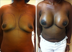 African American Breast Implants Patient Before & After Photo 1