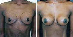 African American Breast Implants Patient Before & After Photo 1