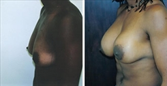 African American Breast Implants Patient Before & After Photo 1