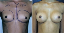 African American Breast Implants Patient Before & After Photo 1