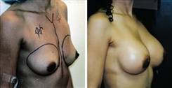 African American Breast Implants Patient Before & After Photo 1