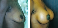 African American Breast Implants Patient Before & After Photo 1