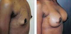 African American Breast Implants Patient Before & After Photo 1