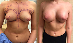 Breast Augmentation Patient Before & After Photo 1