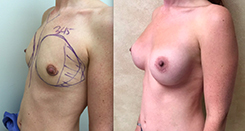 Breast Augmentation Patient Before & After Photo 1