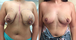 Breast Reduction Patient Before & After Photo 1