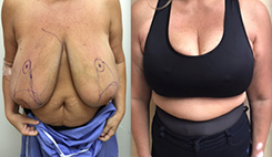 Breast Procedures Patient Before & After Photo 1