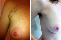 Bra Buldge Patient Before & After Photo 1