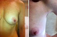 Bra Buldge Patient Before & After Photo 1