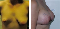 Breast Asymmetry Patient Before & After Photo 1