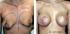 Breast Procedures Patient Before & After Photo 1