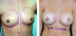 Breast Procedures Patient Before & After Photo 1