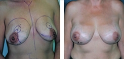 Breast Asymmetry Patient Before & After Photo 1