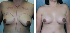 Breast Procedures Patient Before & After Photo 1