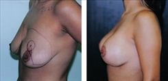 Breast Procedures Patient Before & After Photo 1