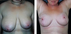 Breast Procedures Patient Before & After Photo 1