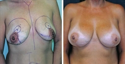 Breast Procedures Patient Before & After Photo 1