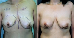 Breast Asymmetry Patient Before & After Photo 1