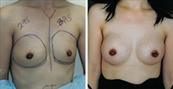 Breast Asymmetry Patient Before & After Photo 1