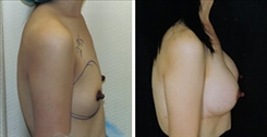 Breast Asymmetry Patient Before & After Photo 1