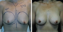 Breast Procedures Patient Before & After Photo 1