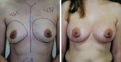 Breast Asymmetry Patient Before & After Photo 1