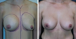 Breast Asymmetry Patient Before & After Photo 1