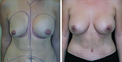 Breast Procedures Patient Before & After Photo 1