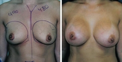 Breast Asymmetry Patient Before & After Photo 1