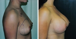 Breast Procedures Patient Before & After Photo 1