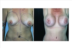 Breast Procedures Patient Before & After Photo 1