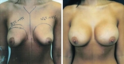 Breast Asymmetry Patient Before & After Photo 1