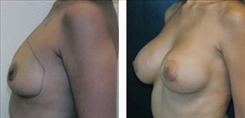 Breast Asymmetry Patient Before & After Photo 1