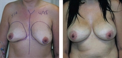 Breast Procedures Patient Before & After Photo 1