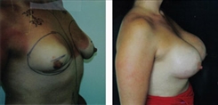 Breast Procedures Patient Before & After Photo 1