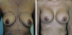 Breast Procedures Patient Before & After Photo 1