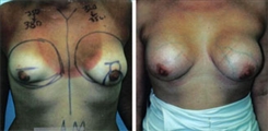 Breast Asymmetry Patient Before & After Photo 1