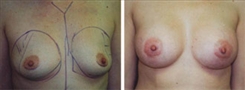 Breast Asymmetry Patient Before & After Photo 1