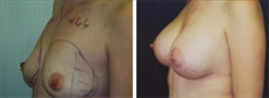 Breast Asymmetry Patient Before & After Photo 1