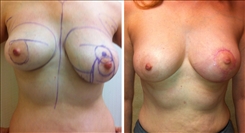 Breast Procedures Patient Before & After Photo 1