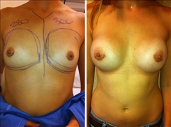 Breast Procedures Patient Before & After Photo 1