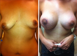 Breast Procedures Patient Before & After Photo 1