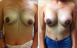 Breast Asymmetry Patient Before & After Photo 1