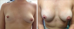 Breast Asymmetry Patient Before & After Photo 1