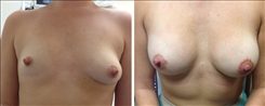 Breast Procedures Patient Before & After Photo 1