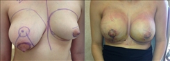 Breast Procedures Patient Before & After Photo 1