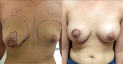 Breast Procedures Patient Before & After Photo 1