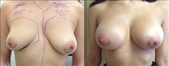 Breast Procedures Patient Before & After Photo 1