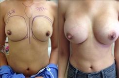 Breast Asymmetry Patient Before & After Photo 1